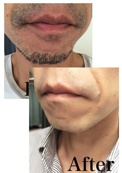 メンズ脱毛　ひげ脱毛