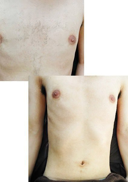 メンズ脱毛　ボディ脱毛