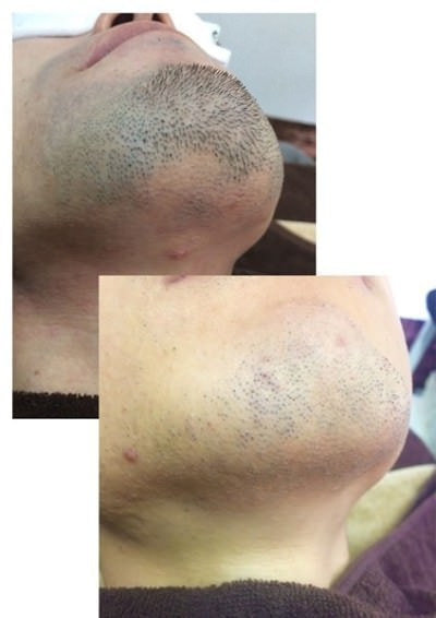 メンズ脱毛　ヒゲ脱毛